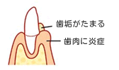 歯周病の進行1