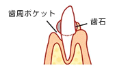 歯周病の進行
